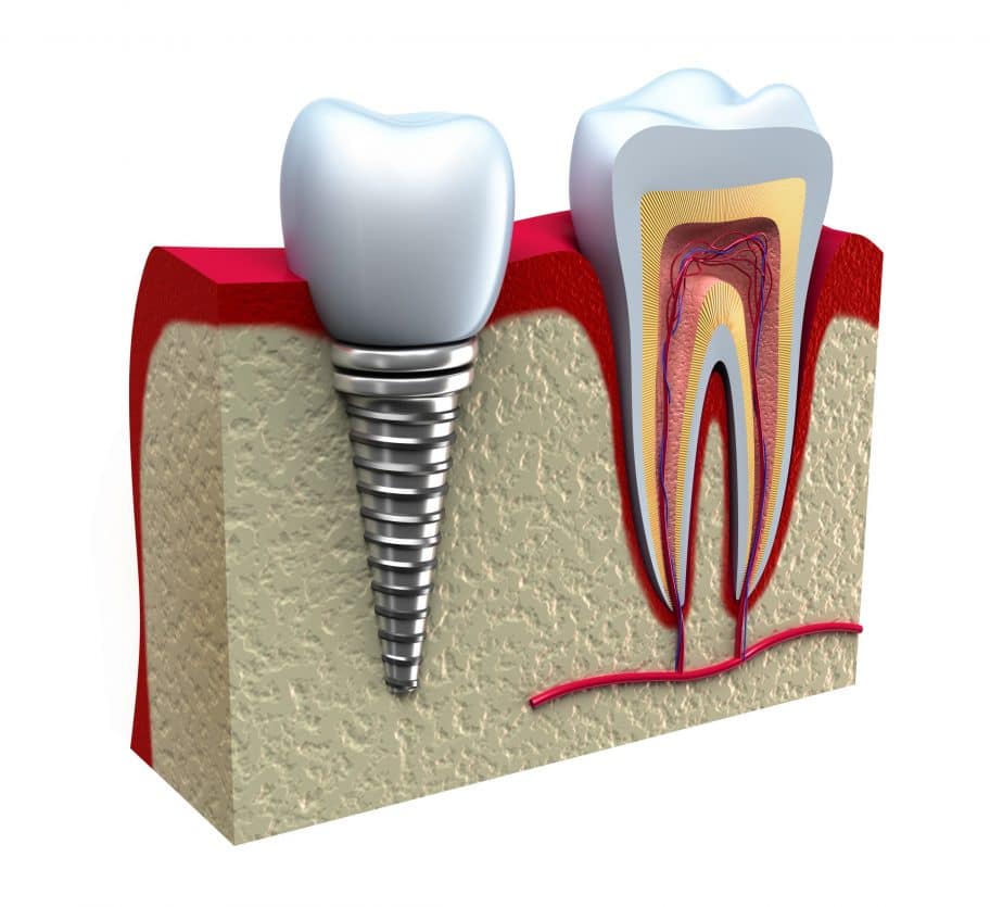 implant images