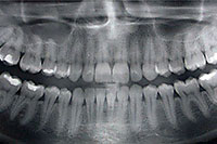 Panoramic Digital X-Ray
