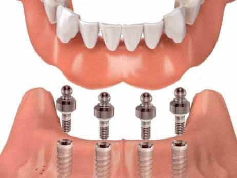 snap on dentures